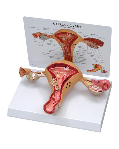 Modèle Anatomique De L\'Utérus Ovaire