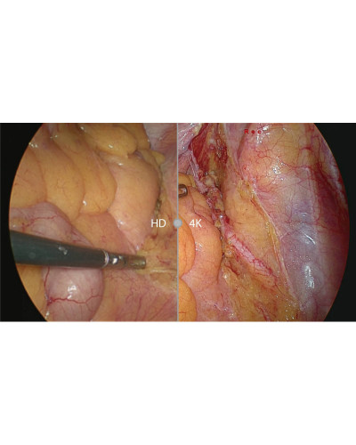 Colonne d'endoscopie vidéo (Coelioscopie-laparoscopie) Haute Définition, Modèle SV-M4K30