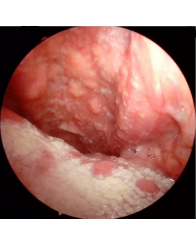 Endoscope rigide 70 °, Diamètre 4 mm, longueur 180 mm (Sinuscope)