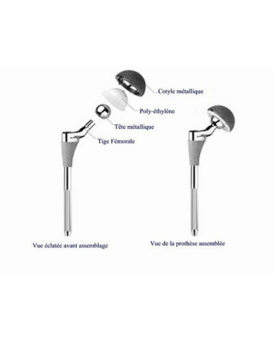 Set de Prothèse de hanche modulaire de première intention, non cimentée