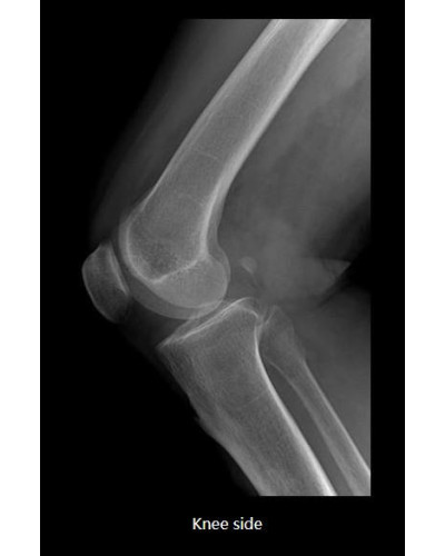 Appareil de radiographie numérique ASR-6150C (F) monté sur sol