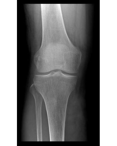Appareil de radiographie numérique ASR-6150C (F) monté sur sol