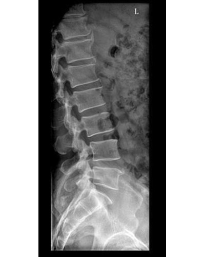 Appareil de radiographie numérique ASR-6150C (F) monté sur sol