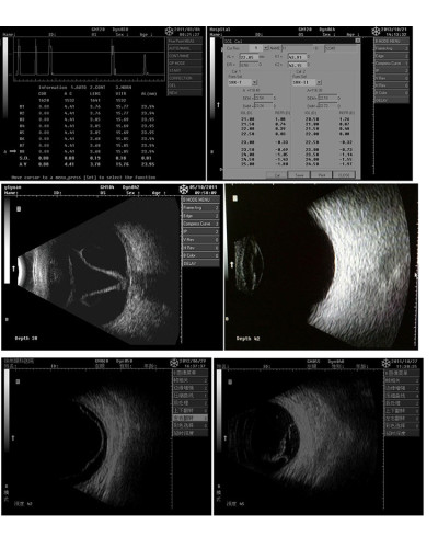 Echographe ophtalmologique AB, Modèle ODU8