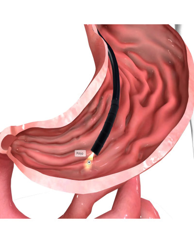 Fibroscope Gastro-intestinal
